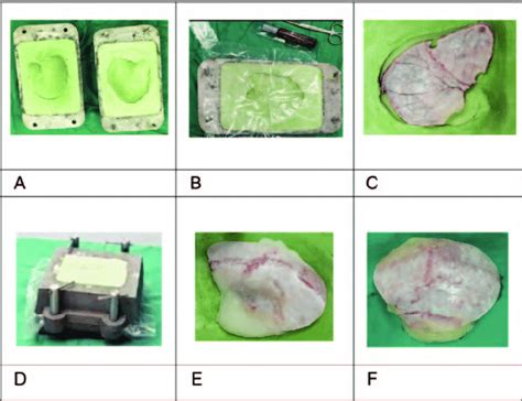  Implant Grade Polymethyl Methacrylate : Un Géant Silencieux de la Chirurgie Reconstructrice !